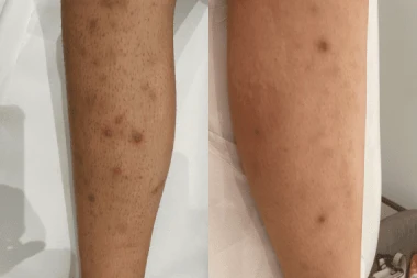 Poils incarnés, boutons : dites stop grâce à l’épilation laser