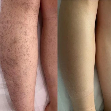 Épilation Laser des Jambes : Séances, Résultats et Prix | La Clinique Laser