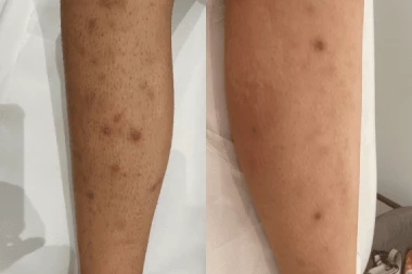 Poils incarnés, boutons : dites stop grâce à l’épilation laser