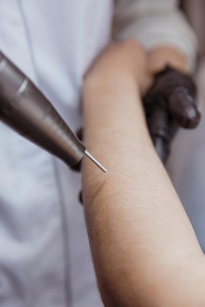 Bleaching sur les bras à Marseille et Nice