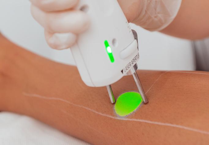 Epilation laser Marseille et Nice