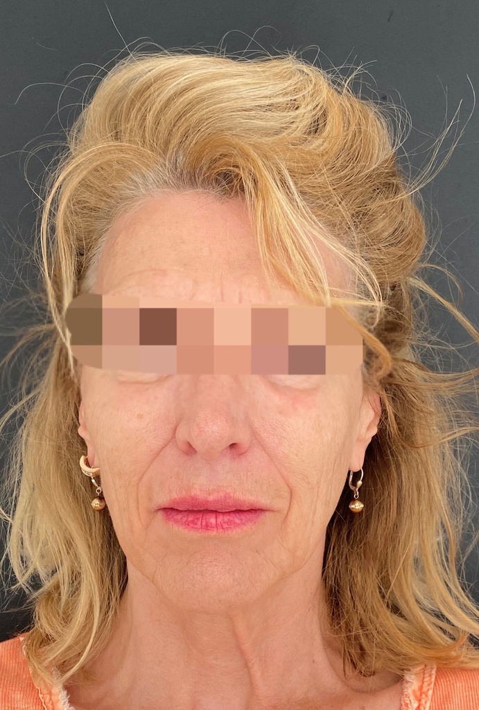 Après injections La Clinique Laser