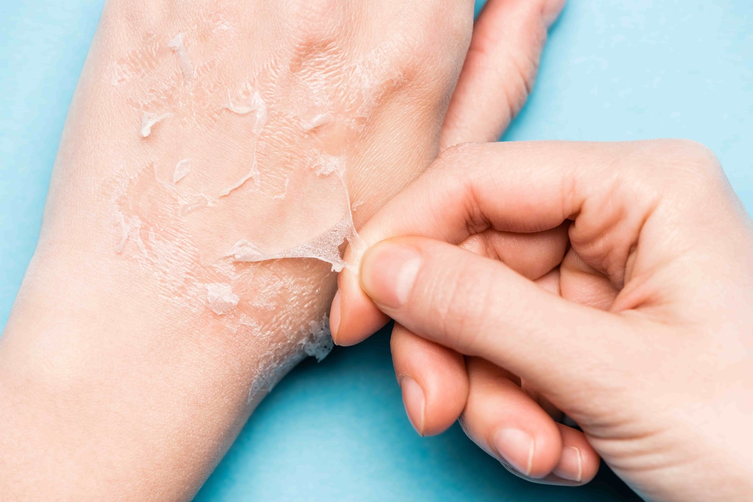 Différences laser et peeling
