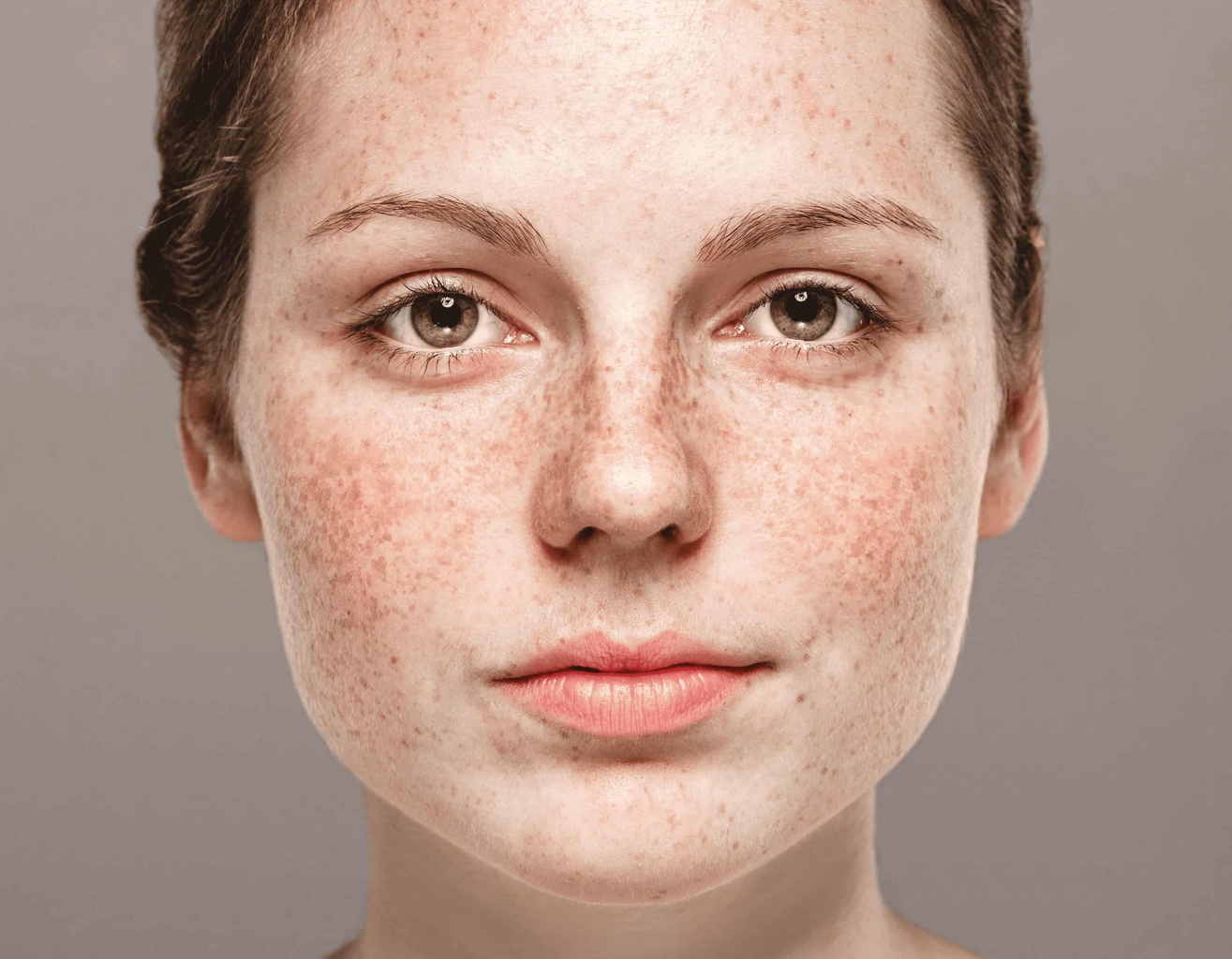 Causes et traitements du mélasma