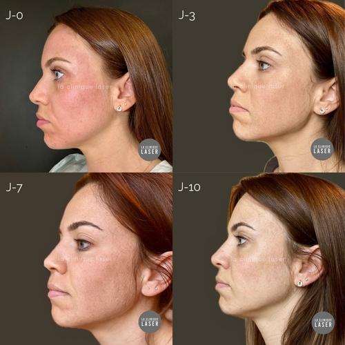 evolution-apres-lasemd.JPG