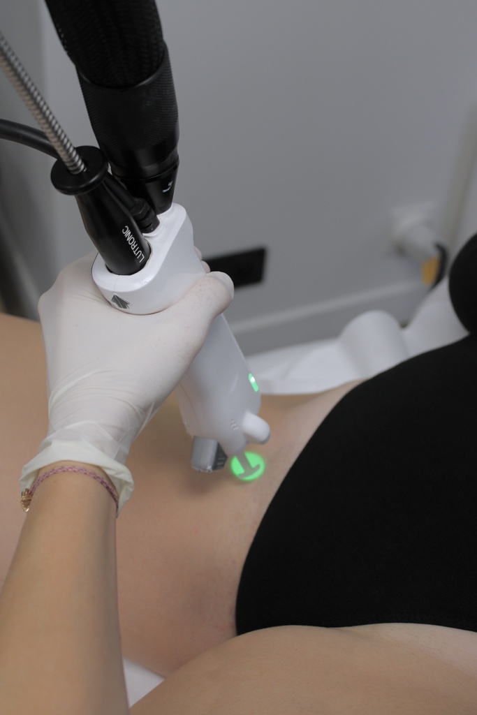 epilation laser marseille