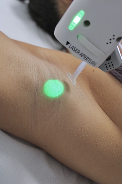 laser-epilatoire la clinique laser