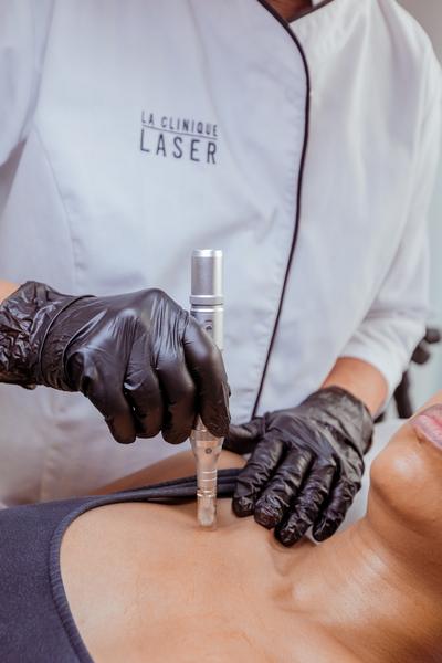 microneedling nice