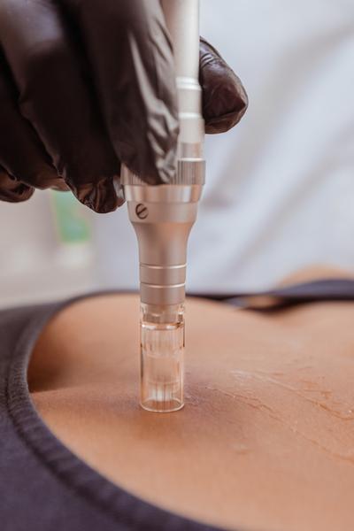 microneedling marseille