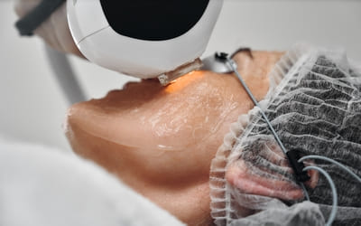 traitements au laser marseille